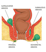 Tight anal sphincter